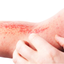Managing Atopic Dermatitis icon