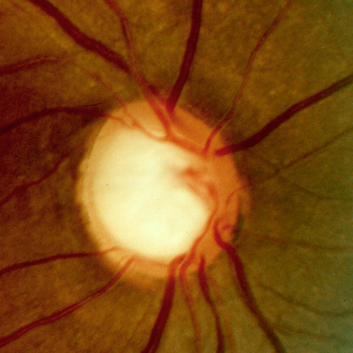 Glaucoma Calc app icon